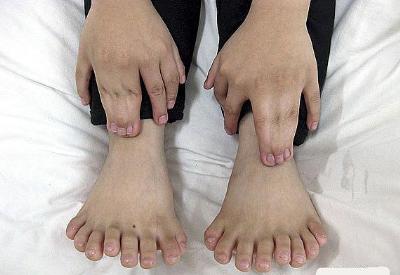 31 parmaklı çocuk neyin sonucu?