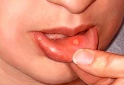 Ağızda çıkan yaralara dikkat!