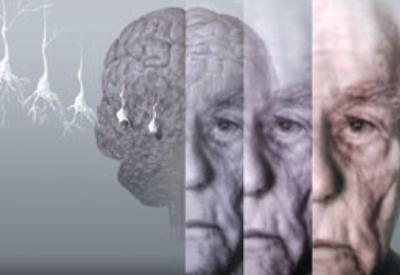 Alzheimer sağlıklı insanlarda da teşhis edilebilecek