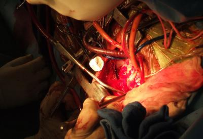 Baypasların yüzde 12-20’si gereksiz