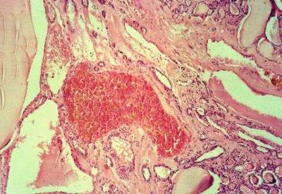 Türkiye'de sık görülen hastalıklardan olan 'guatr öldürebilir'