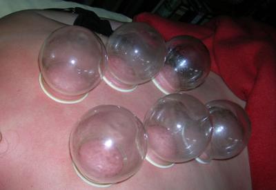 70 hastalığın şifası hacamatta!