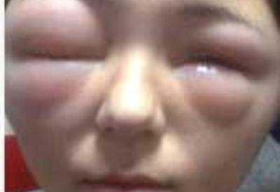 Saç boyası genç kızı bu hale getirdi